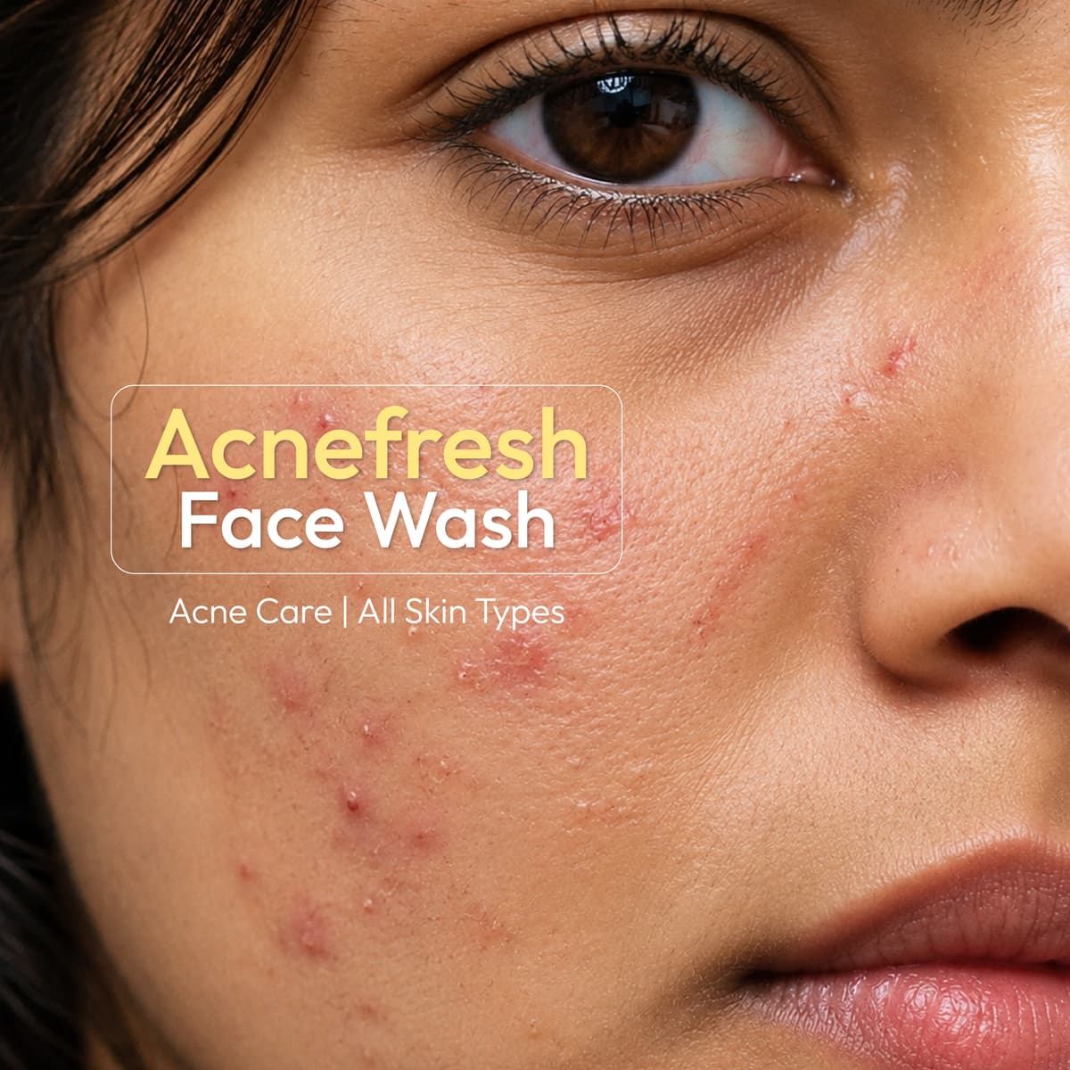 Acnifresh Face Wash — view 2